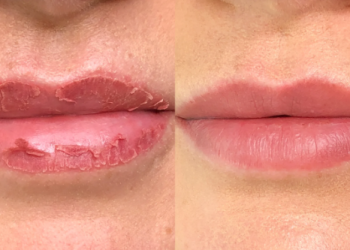 Permanent Lip Color Healing Process