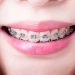 The Science Behind Straightening Teeth: How Orthodontics Creates Healthier Smiles